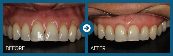 Pinhole Surgical Technique Philadelphia | Receding Gums Treatment