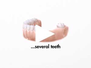 play dental implants a natural treatment for missing teeth video